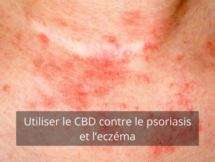 Utiliser le CBD contre le psoriasis et l’eczéma